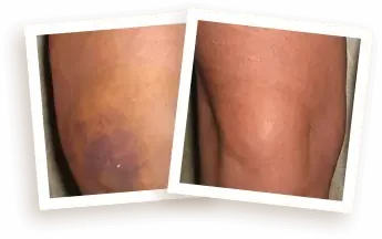 Ilustrasi lutut (contoh)